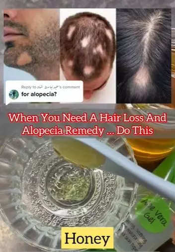 Tumbuhkan rambut pitak di area dahi pakai madu Berbagai sumber