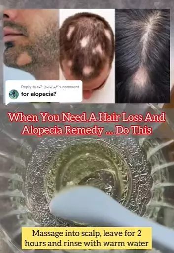 Tumbuhkan rambut pitak di area dahi pakai madu Berbagai sumber