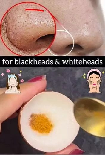 Hempas komedo hitam di hidung dan dagu Berbagai sumber