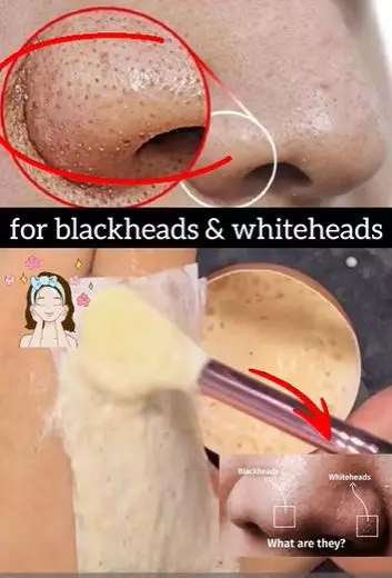 Hempas komedo hitam di hidung dan dagu Berbagai sumber