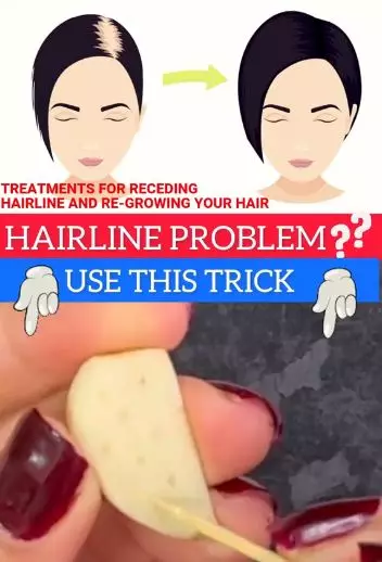 Tumbuhkan rambut tipis area depan Berbagai sumber Tumbuhkan rambut tipis area depan Berbagai sumber