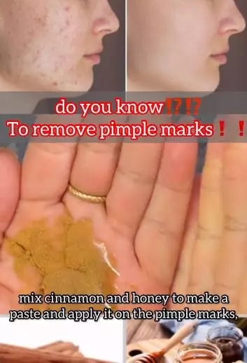Pudarkan bekas jerawat membandel di wajah pakai madu Berbagai sumber