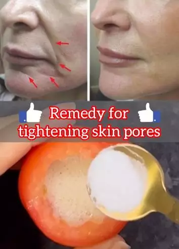 Kencangkan wajah kendur dan pori besar Berbagai sumber