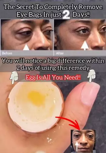 Kencangkan kerutan area kantung mata Berbagai sumber