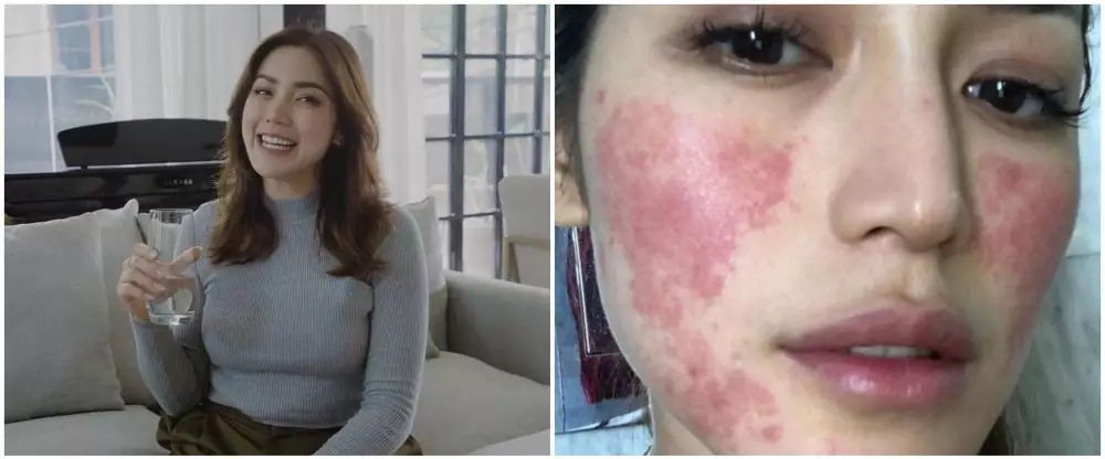 cerita seleb kena efek samping perawatan © instagram