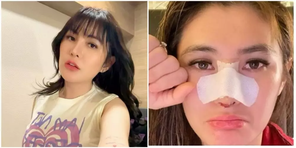 cerita seleb kena efek samping perawatan © instagram