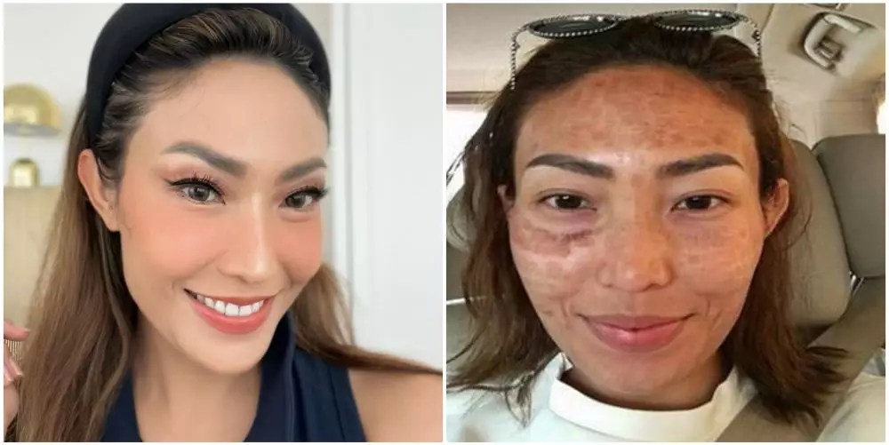 cerita seleb kena efek samping perawatan © instagram