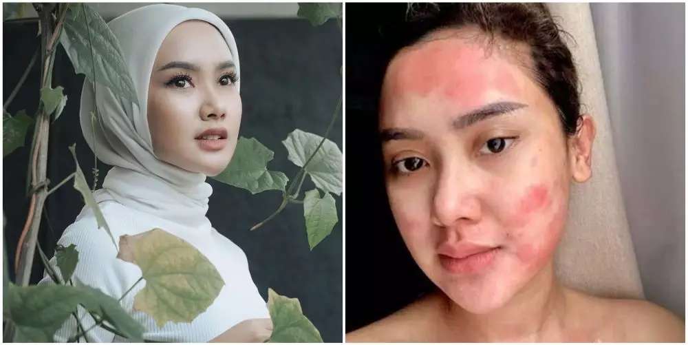 cerita seleb kena efek samping perawatan © instagram