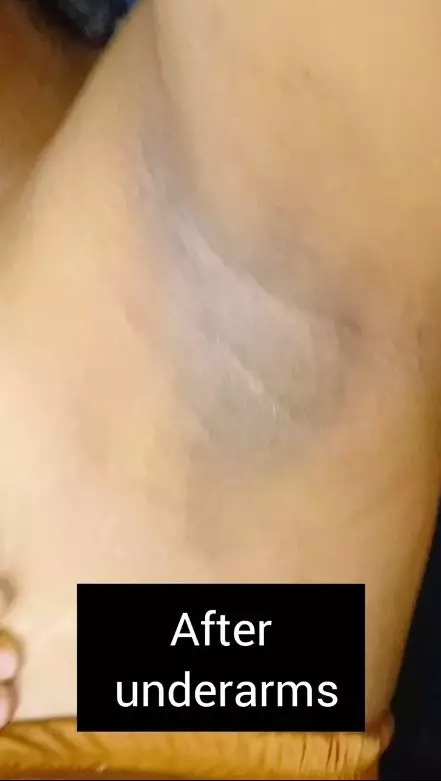 cerahkan kulit ketiak yang hitam pekat. berbagai sumber