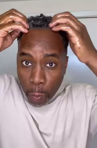 Ketombe akibat kulit kepala mengelupas Berbagai sumber