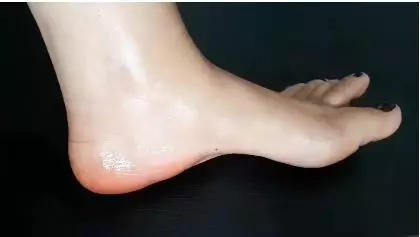 cara atasi tumit pecah-pecah berbagai sumber cara atasi tumit pecah-pecah berbagai sumber