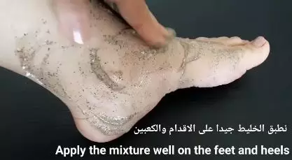 cara atasi tumit pecah-pecah berbagai sumber cara atasi tumit pecah-pecah berbagai sumber