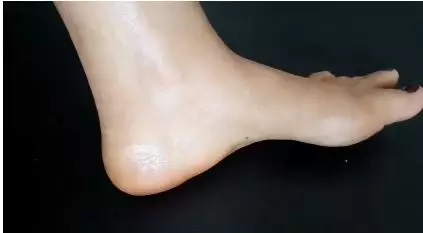 cara atasi tumit pecah-pecah berbagai sumber cara atasi tumit pecah-pecah berbagai sumber