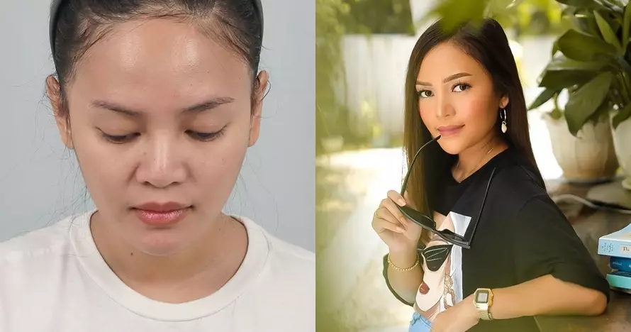 Potret wajah 23 seleb sebelum dan sesudah operasi plastik berbagai sumber