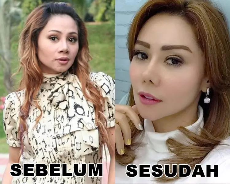 Seleb sebelum dan sesudah lakukan filler Berbagai sumber