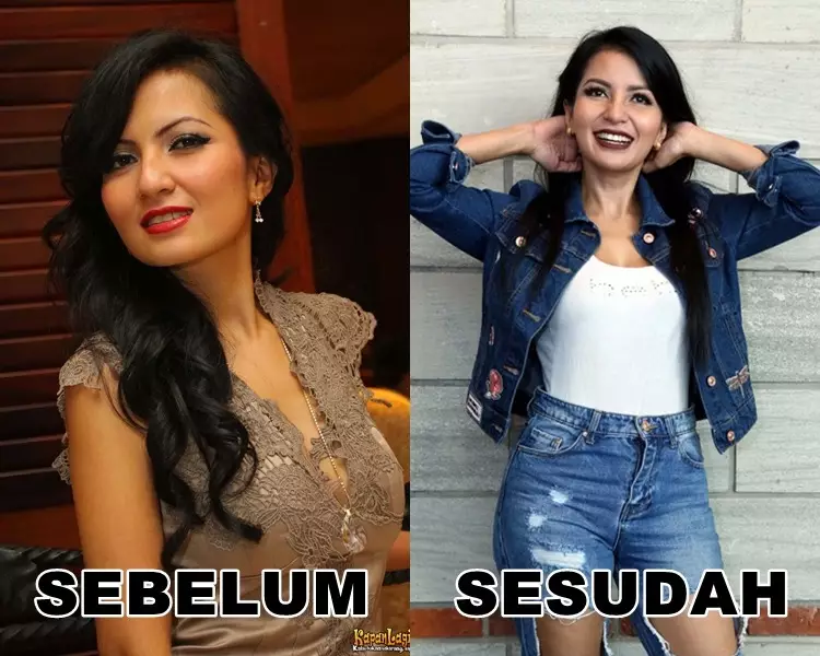 Seleb sebelum dan sesudah lakukan filler Berbagai sumber