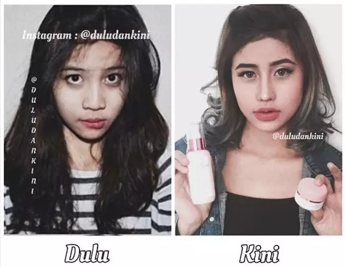 Seleb sebelum dan sesudah lakukan filler Berbagai sumber