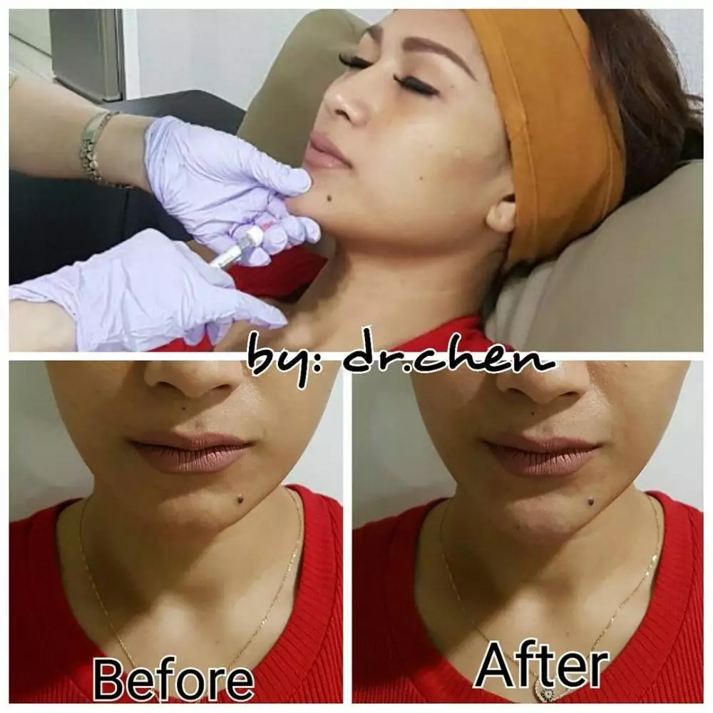 Seleb sebelum dan sesudah lakukan filler Berbagai sumber