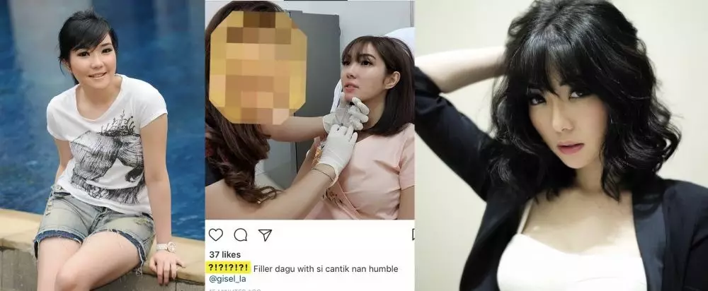 Seleb sebelum dan sesudah lakukan filler Berbagai sumber