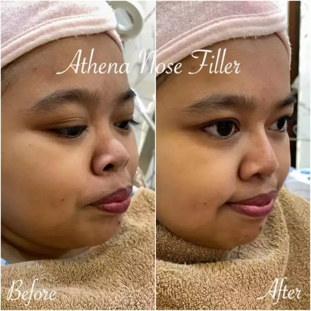 Seleb sebelum dan sesudah lakukan filler Berbagai sumber