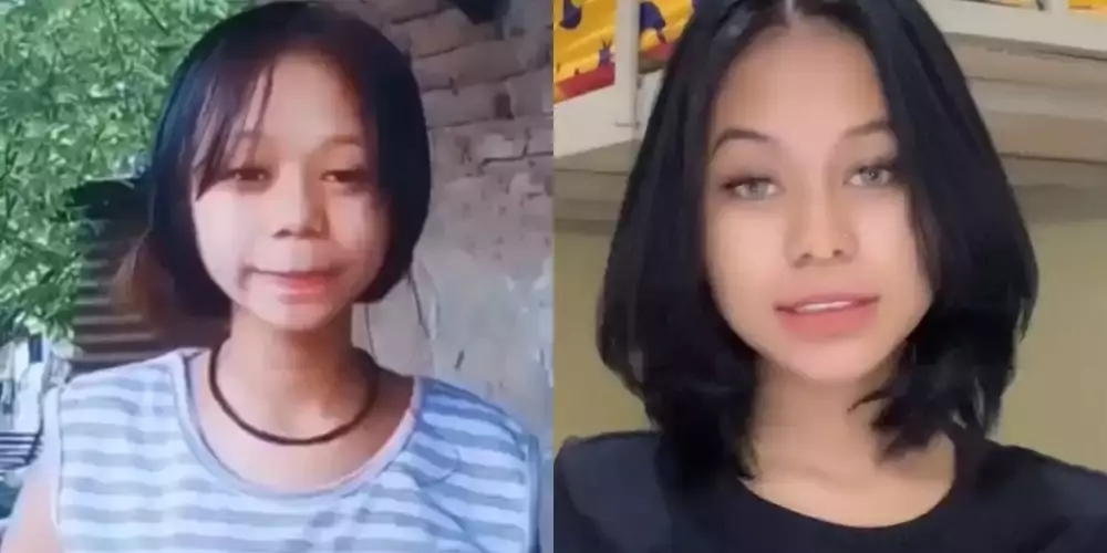 Seleb sebelum dan sesudah lakukan filler Berbagai sumber