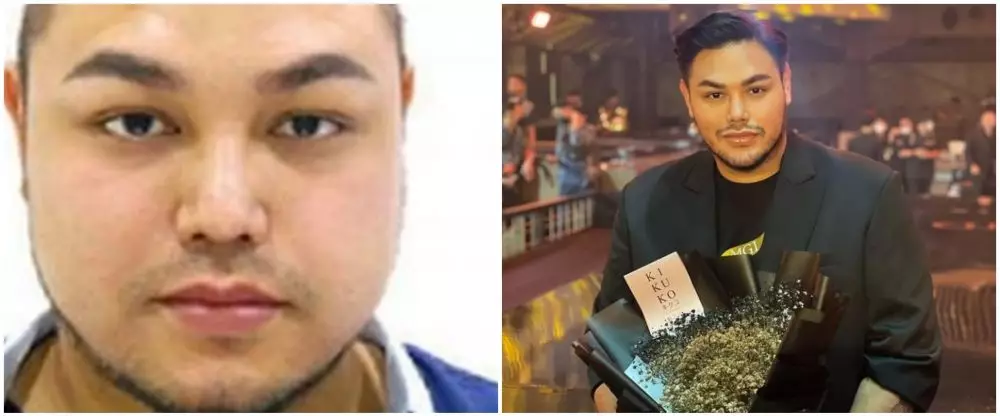 Seleb sebelum dan sesudah lakukan filler Berbagai sumber