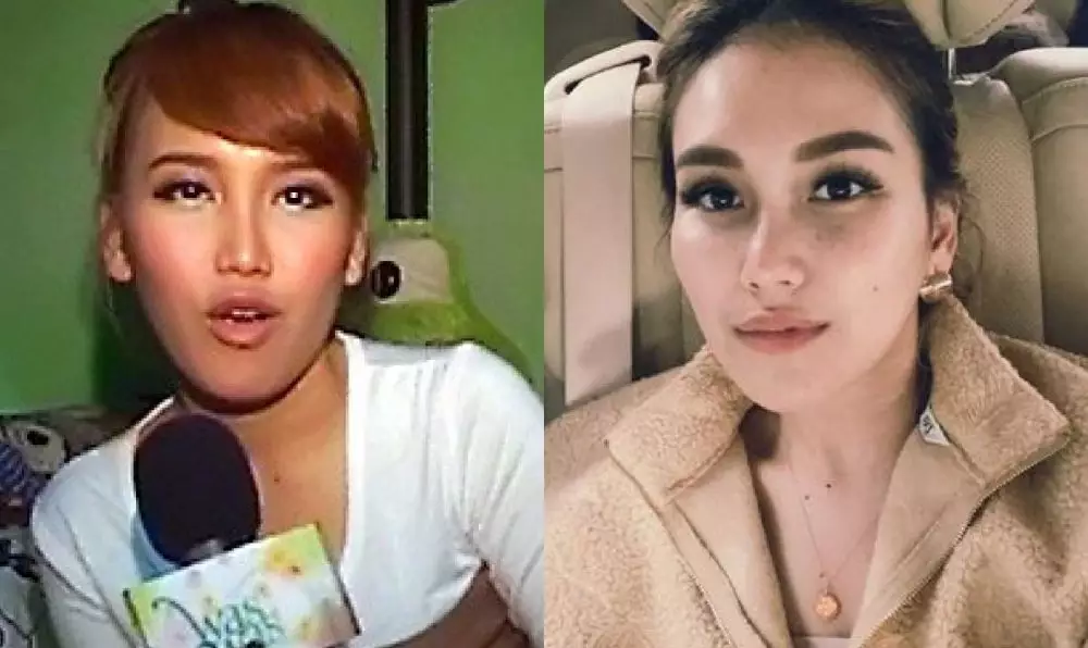 Seleb sebelum dan sesudah lakukan filler Berbagai sumber