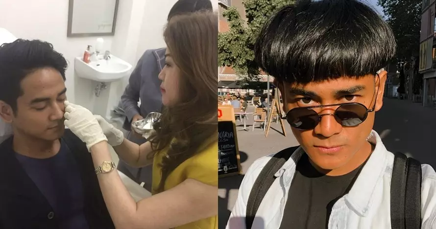 Seleb sebelum dan sesudah suntik botoks Berbagai sumber