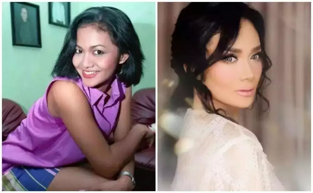 Seleb sebelum dan sesudah suntik botoks Berbagai sumber