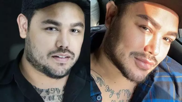 seleb sebelum dan sesudah filler bibir berbagai sumber