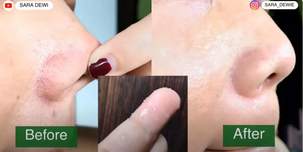 wanita ini bagikan cara ampuh usir komedo berbagai sumber