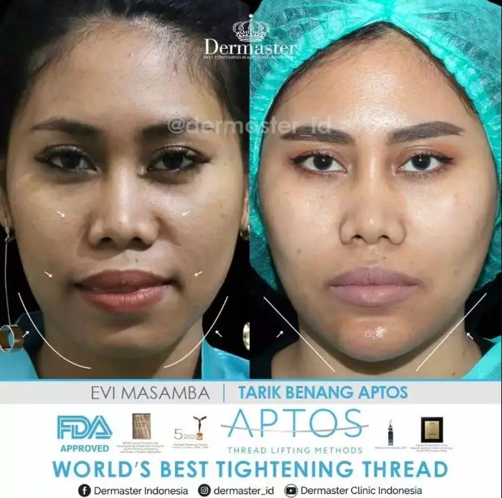 Potret 13 penyanyi sebelum dan sesudah tanam benang berbagai sumber Potret 13 penyanyi sebelum dan sesudah tanam benang berbagai sumber