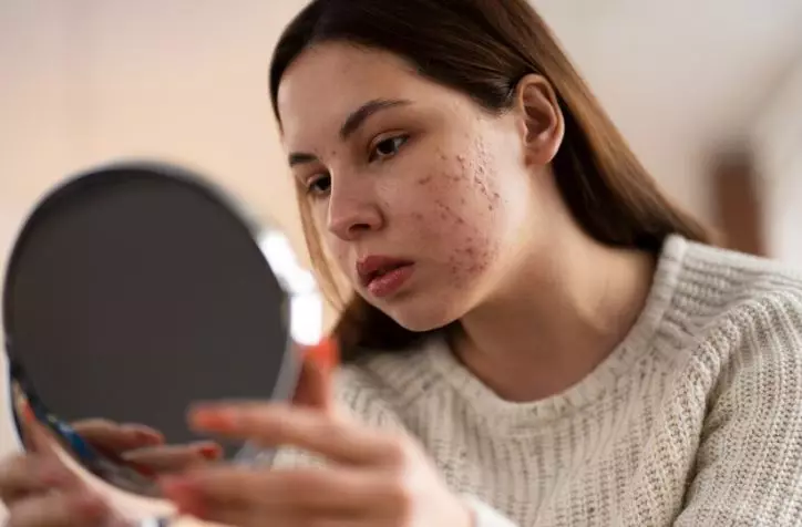 cara menghilangkan bekas jerawat berbagai sumber