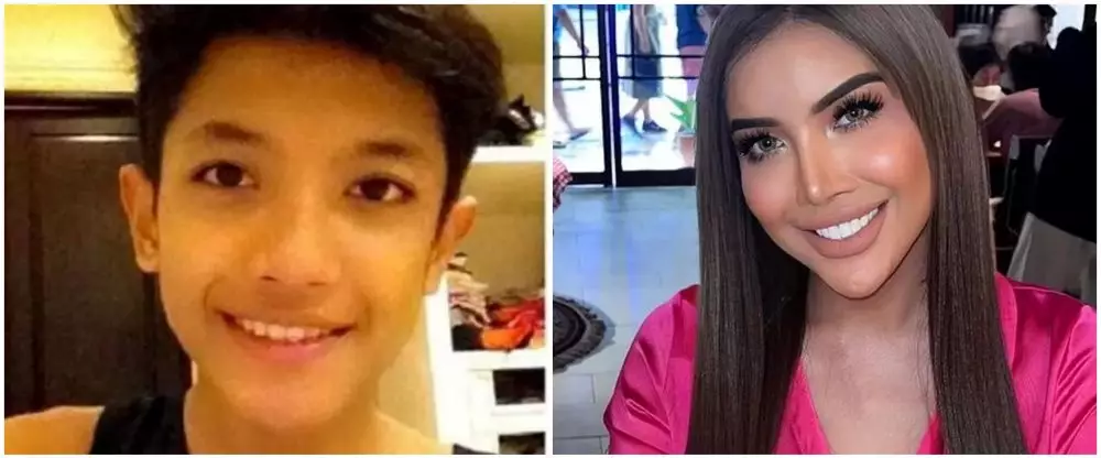 19 Seleb sebelum dan sesudah veneer gigi Berbagai sumber