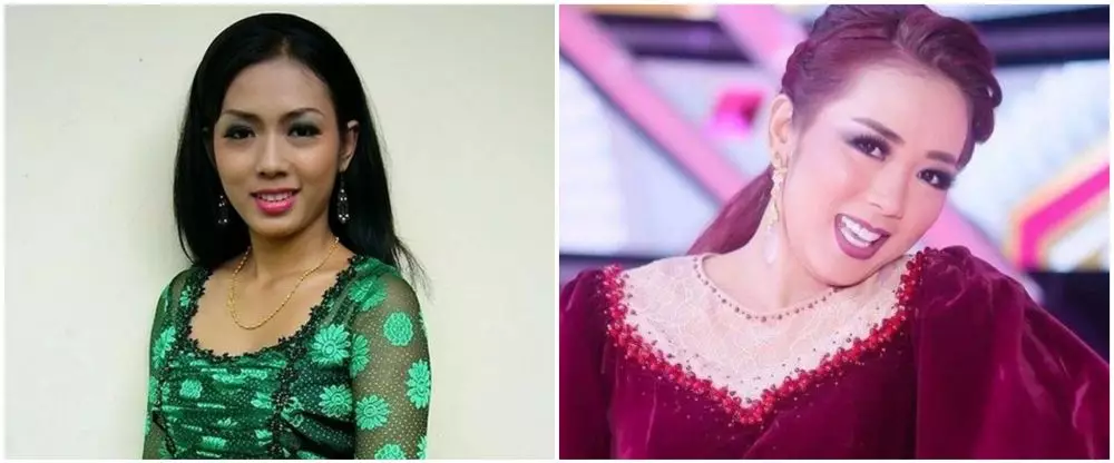 19 Seleb sebelum dan sesudah veneer gigi Berbagai sumber