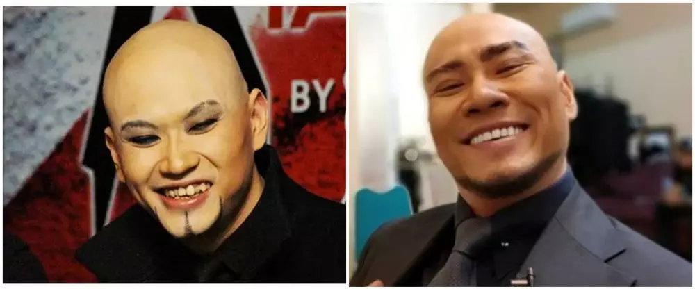 19 Seleb sebelum dan sesudah veneer gigi Berbagai sumber