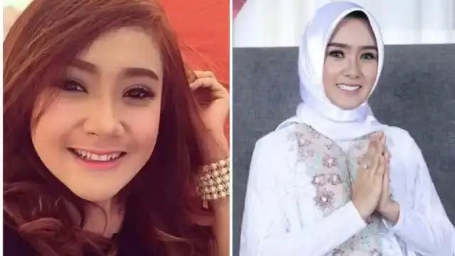 19 Seleb sebelum dan sesudah veneer gigi Berbagai sumber