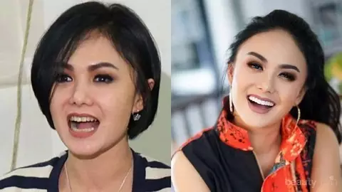 19 Seleb sebelum dan sesudah veneer gigi Berbagai sumber