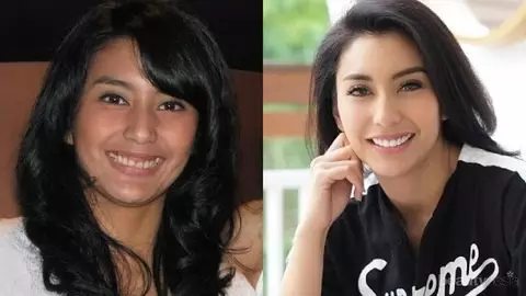 19 Seleb sebelum dan sesudah veneer gigi Berbagai sumber