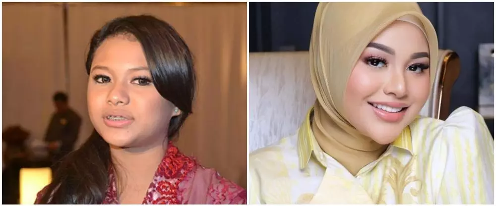 19 Seleb sebelum dan sesudah veneer gigi Berbagai sumber