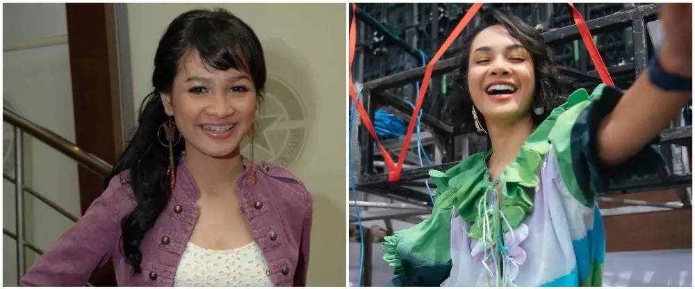 19 Seleb sebelum dan sesudah veneer gigi Berbagai sumber