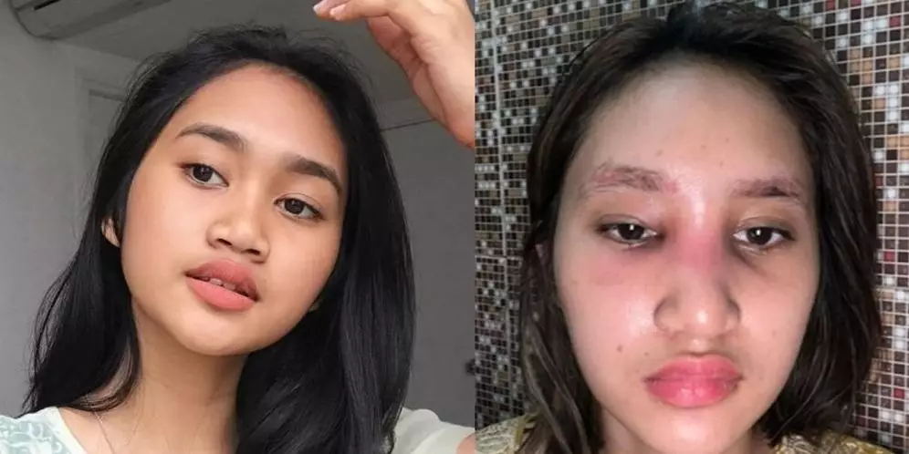 Seleb pernah jadi korban efek samping treatment kecantikan Berbagai sumber