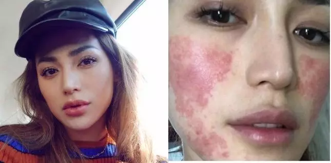 Seleb pernah jadi korban efek samping treatment kecantikan Berbagai sumber