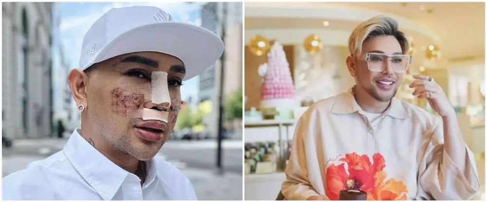 potret sebelum dan sesudah seleb pria operasi hidung berbagai sumber potret sebelum dan sesudah seleb pria operasi hidung berbagai sumber