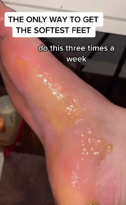 Atasi kaki kering ini pakai manuka honey Berbagai sumber Atasi kaki kering ini pakai manuka honey Berbagai sumber