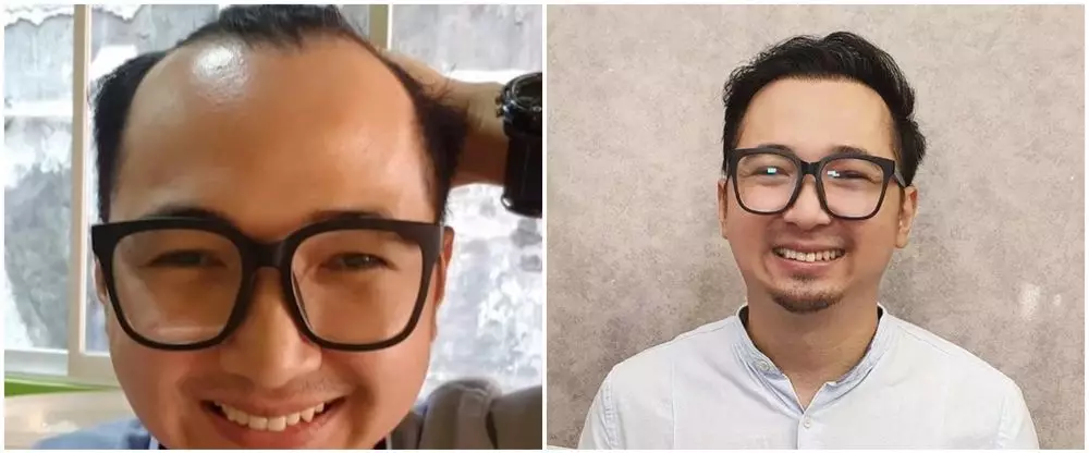 Potret seleb sebelum dan sesudah transplantasi rambut Berbagai sumber Potret seleb sebelum dan sesudah transplantasi rambut Berbagai sumber