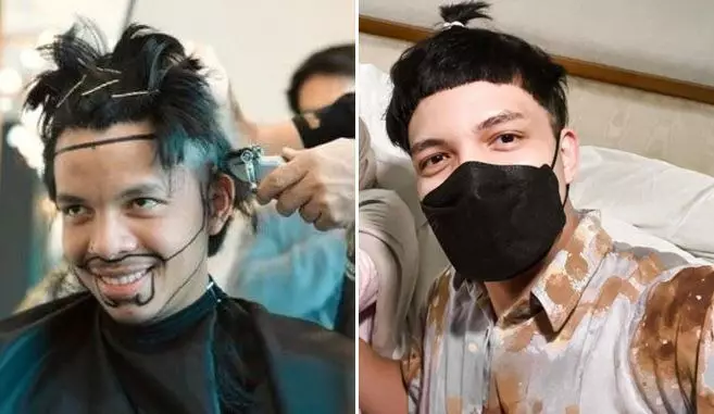 Potret seleb sebelum dan sesudah transplantasi rambut Berbagai sumber Potret seleb sebelum dan sesudah transplantasi rambut Berbagai sumber