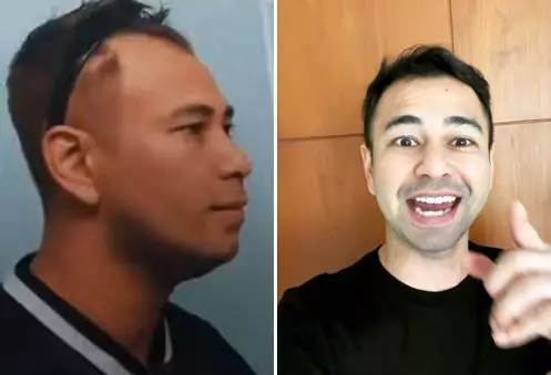 Potret seleb sebelum dan sesudah transplantasi rambut Berbagai sumber Potret seleb sebelum dan sesudah transplantasi rambut Berbagai sumber
