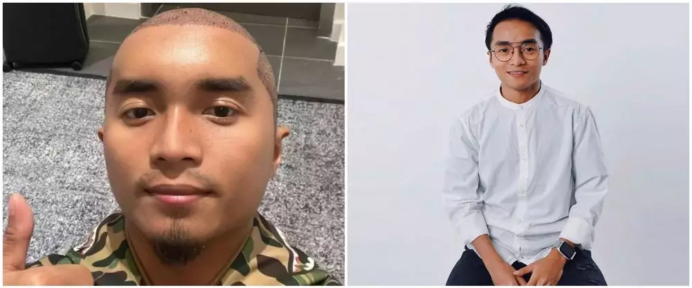 Potret seleb sebelum dan sesudah transplantasi rambut Berbagai sumber Potret seleb sebelum dan sesudah transplantasi rambut Berbagai sumber