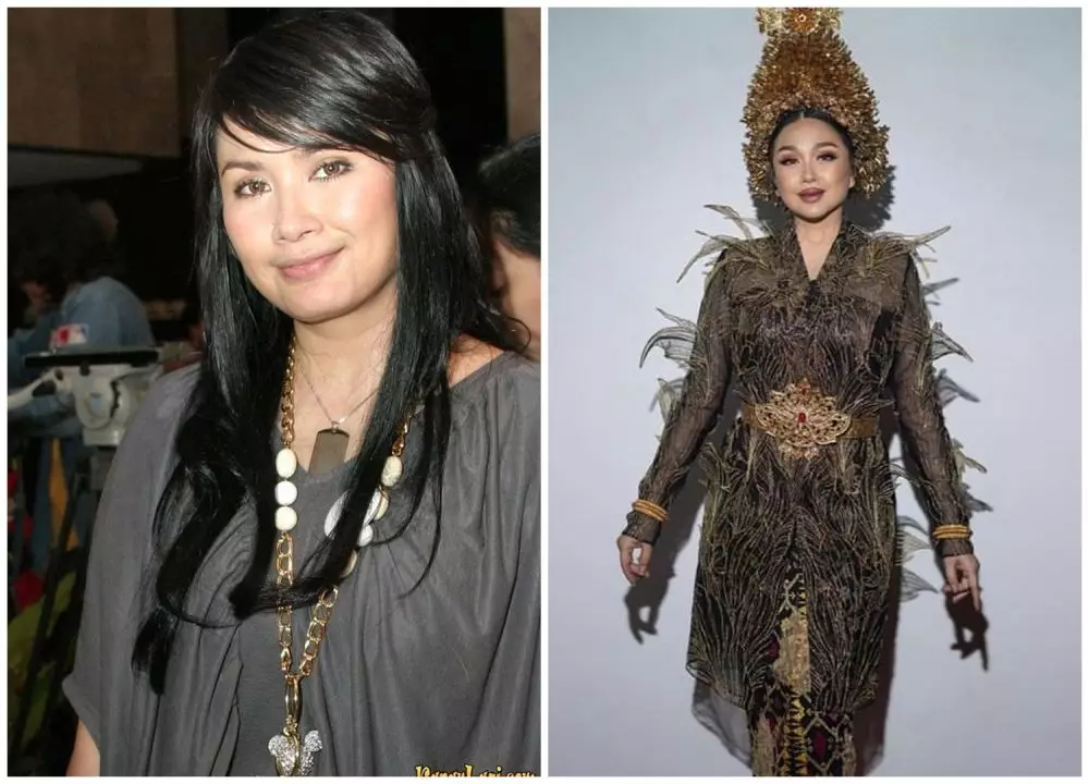 Potret sebelum dan sesudah 9 seleb sedot lemak berbagai sumber